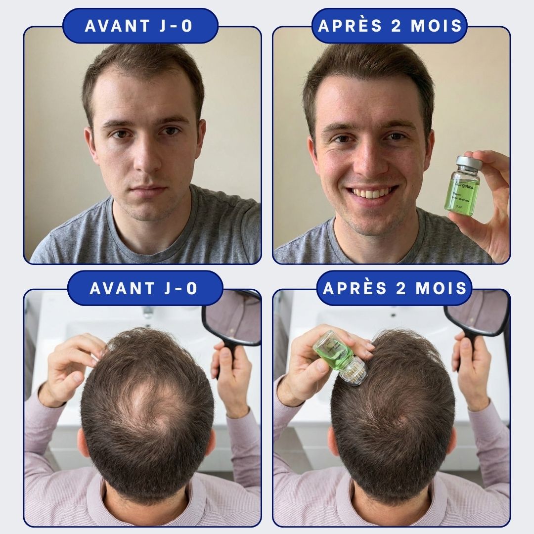 Micro-Infusion Capillaire + Cure Active